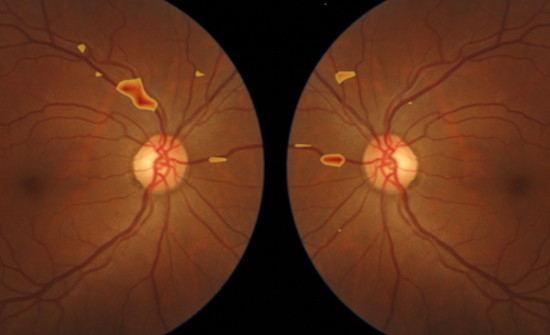 Aitheroscope, el proyecto español finalista de los Premios a la Innovación Social de Fundación MAPFRE